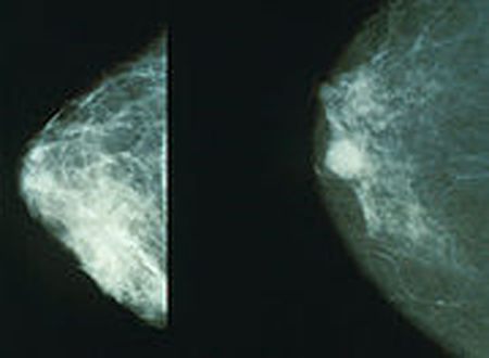 Mamography (Wikipedia)